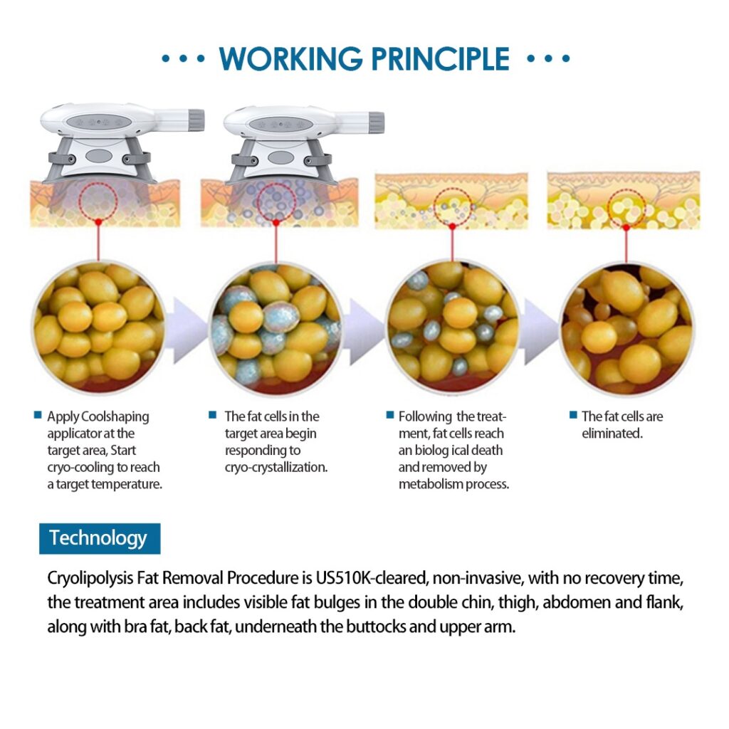 cryo body slimming working principle