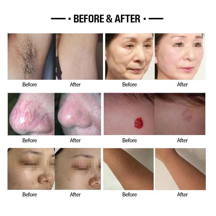 Alexander Laser beauty machine for hair removal