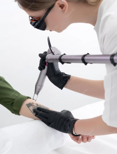 How Does Nd YAG Laser Tattoo Removal Work and Who Is It Best For