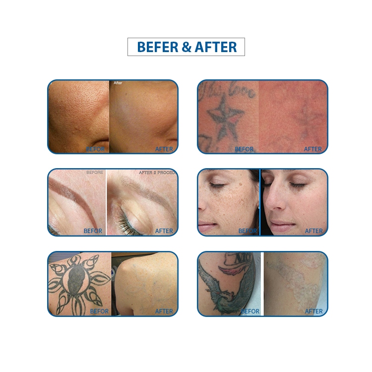 MED-810A-6 tattoo removal machine