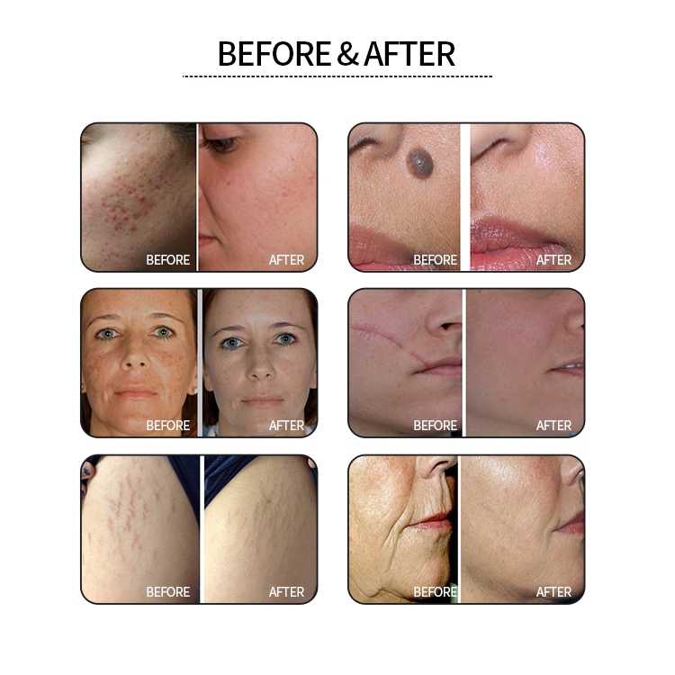 scar skin co2 fractional laser