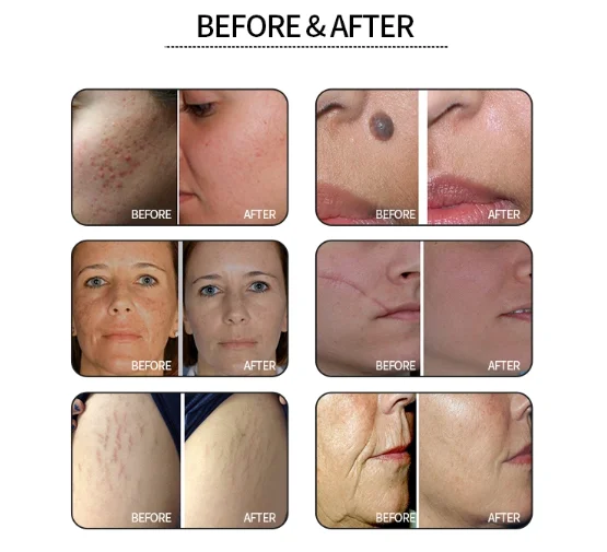 before and after CO₂ fractional laser treatment