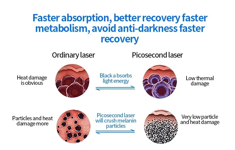 Picosecond vs Q-Switched Laser for Tattoo Removal Which Is Best for Clinics in 2026