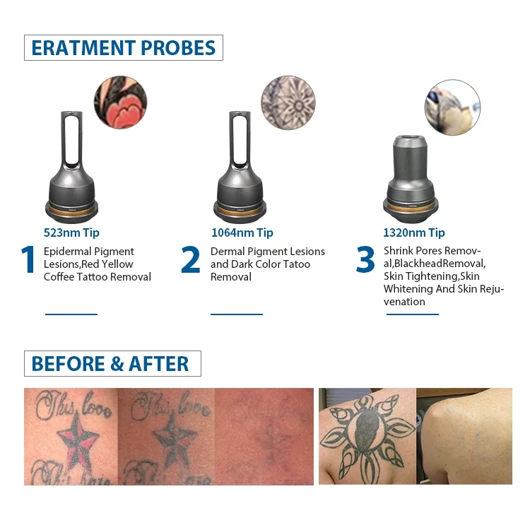 Q Switch ND YAG Laser Tattoo Removal Machine-2