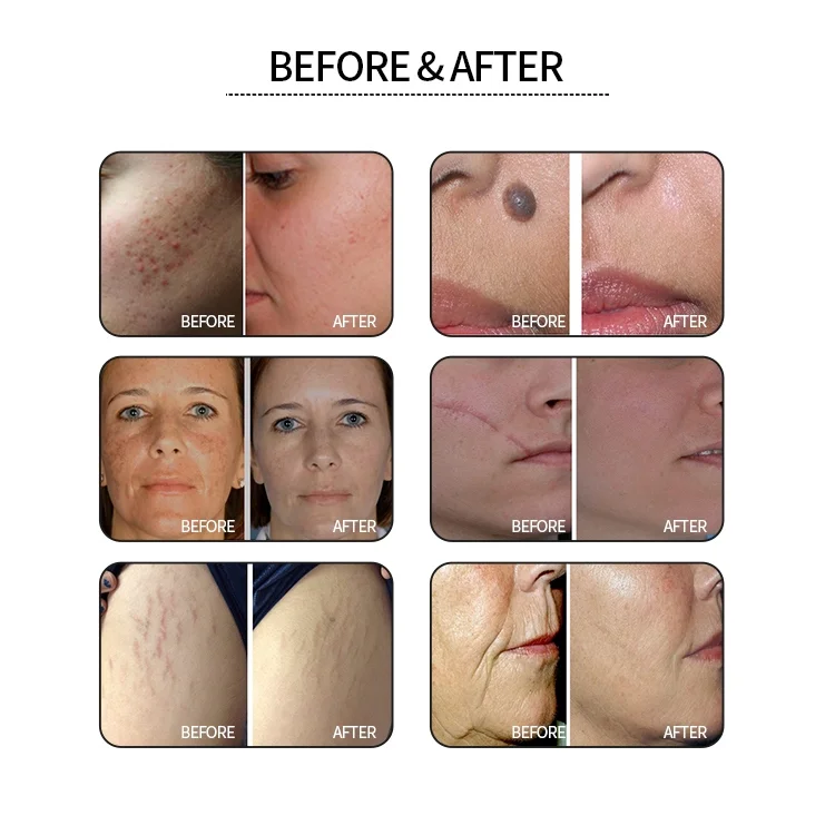 Fractional CO2 Laser Machine-5